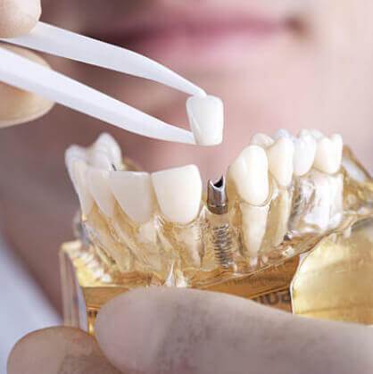 scottsdale dental implants